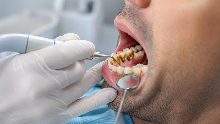 Como tratar o tártaro escuro nos dentes e diminuir o risco de perder nutrientes a curto prazo